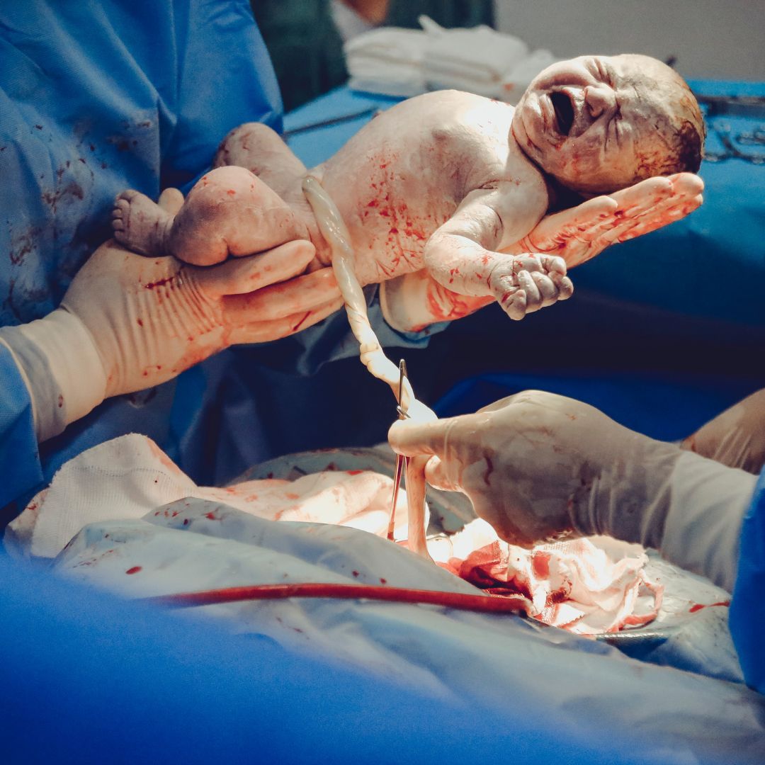 newborn-baby-umbilical-cord-HEX-Hexadecanal-csection